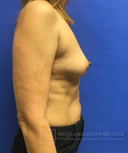 Breast Reconstruction case #2851