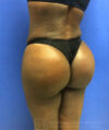 Liposuction case #3605