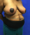 Breast Reduction case #2912