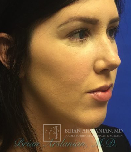 Chin Implant case #2780