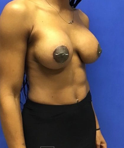 Breast Implants and Lift case #3014