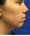 Chin Implant case #2780