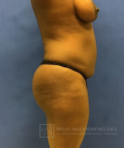 Liposuction case #3605