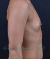 Breast Augmentation case #2520