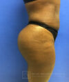 Liposuction case #3605