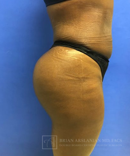 Liposuction case #3605