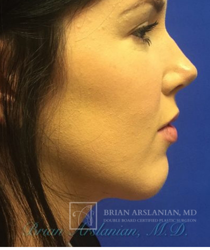 Chin Implant case #2780