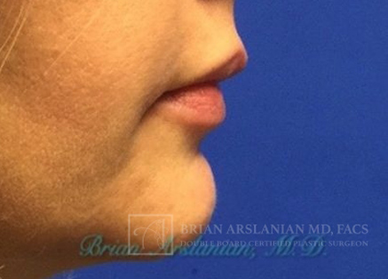 Fillers case #3484