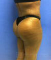 Liposuction case #3605