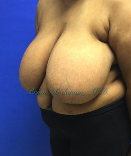 Breast Reduction case #2912