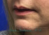 Fillers case #3484