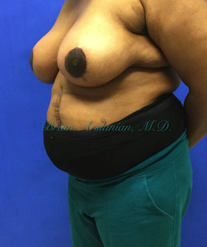 Breast Reduction case #2912