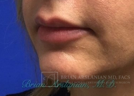 Fillers case #3484