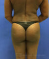 Liposuction case #3605