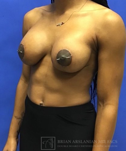 Breast Implants and Lift case #3014