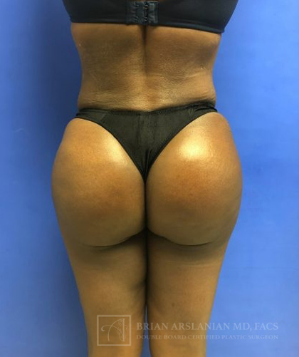 Liposuction case #3605