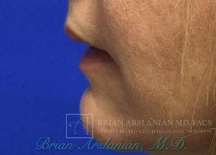 Fillers case #3484