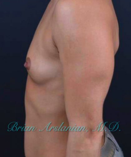 Breast Augmentation case #2520