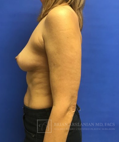 Breast Reconstruction case #2851