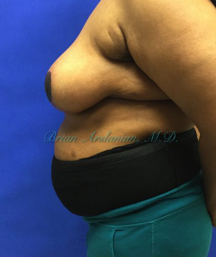 Breast Reduction case #2912