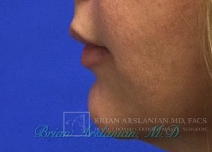 Fillers case #3484