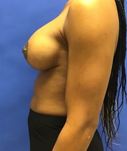 Breast Implants and Lift case #3014