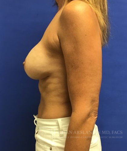 Breast Reconstruction case #2851