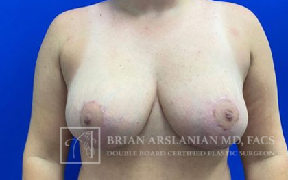 Breast Lift case #4397