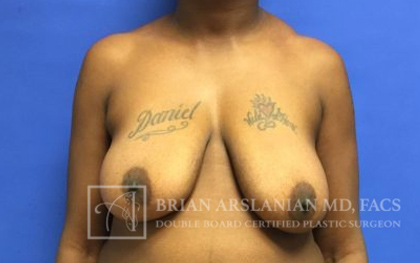 Breast Lift case #4396