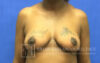 Breast Lift case #4396