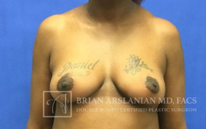 Breast Lift case #4396