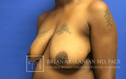 Breast Lift case #4396