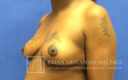 Breast Lift case #4396