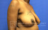 Breast Lift case #4396