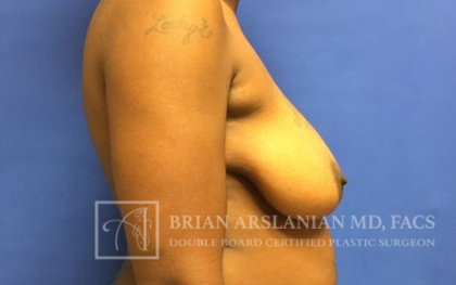 Breast Lift case #4396