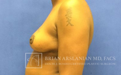 Breast Lift case #4396