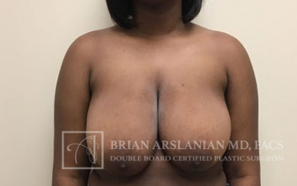 Breast Lift case #4395