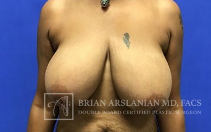 Breast Lift case #4393