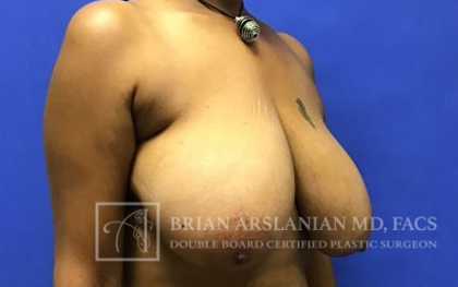 Breast Lift case #4393
