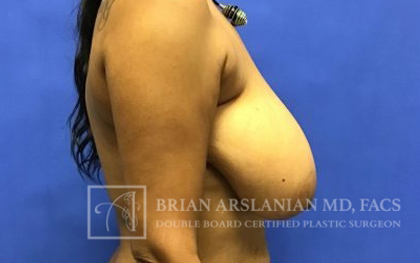 Breast Lift case #4393