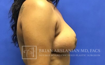 Breast Lift case #4393