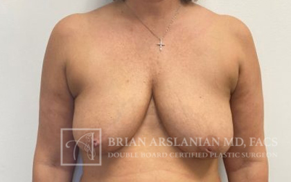 Breast Lift case #4398