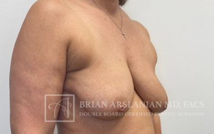 Breast Lift case #4398