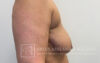 Breast Lift case #4398