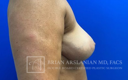 Breast Lift case #4398