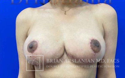 Breast Lift case #4384