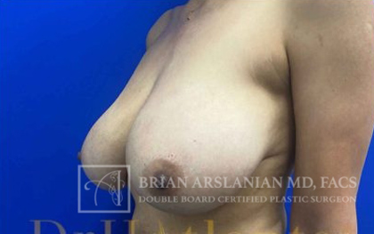 Breast Lift case #4384