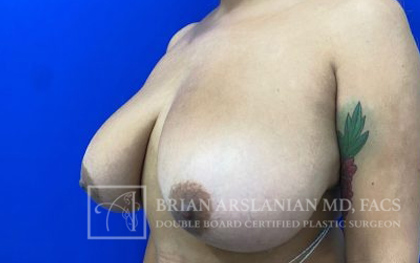 Breast Lift case #4390