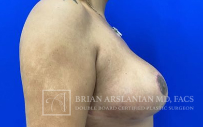 Breast Lift case #4390