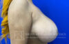 Breast Lift case #4390